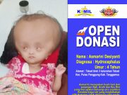 Aztizah (4) Penderita Hydrocephalus, Masih Membutuhkan Bantuan