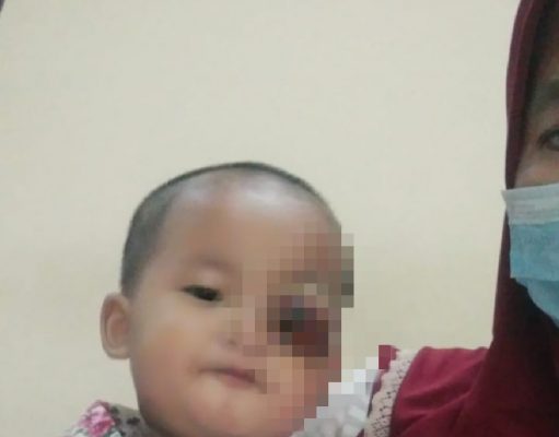 Balita Mengidap Kanker Mata, Butuh Uluran Tangan Dermawan