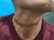 Di Kota Metro, Benang Layangan Sabet Leher pengendara Motor